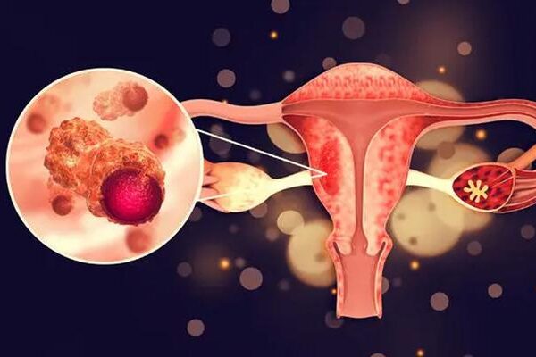 Yumurtalık kanserinde bu belirtilere dikkat! Kadınlarda en sık görülen 3’üncü kanser türü…