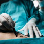 Liposuction Nedir, Nasıl Yapılır? Liposakşın Tedavisi Hangi Durumlarda Uygulanır?